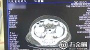 吃楊梅核能清腸道促消化？85歲老太吃1斤楊梅不吐核患腸梗